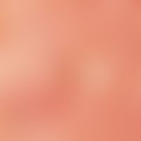 Milia. reflected light microscopy: milia in the cheek area. whitish, pearly round foci (marked wi...