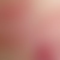 Milia. secondary milia in a blistering primary disease: Multiple, chronically stationary, grouped...