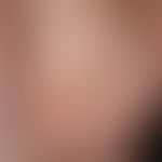 Secondarymilia in an underlying disease with blister formation: Pinhead-sized, spherical, yellowi...