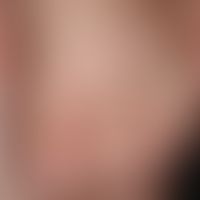 Secondarymilia in an underlying disease with blister formation: Pinhead-sized, spherical, yellowi...