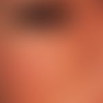 Milia en plaque (milia nevus): 32-year-old healthy female patient; no excessive UV exposure; for ...