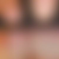 Melanonychia striata longitudinalis (course): Initial findings in 2006, control findings 3 years ...