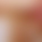 Melanonychia striata longitudinalis. incident light microscopy: Melanonychia striata through mela...