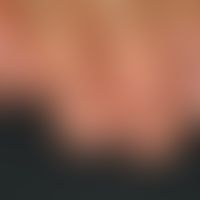 Melanonychia striata longitudinalis. 4 months" (realistic is a duration of years) of persistent b...