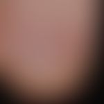 Melanonychia striata longitudinalis. approx. 2 mm wide, light brown stripe in the region of the t...