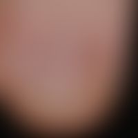 Melanonychia striata longitudinalis. approx. 2 mm wide, light brown stripe in the region of the t...