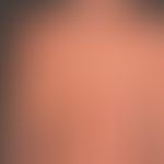 Tinea corporis: ungewöhnlich augedehnte, großflächige,&nbsp;seit mehreren Monaten mit einem poten...