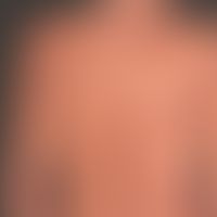 Tinea corporis: ungewöhnlich augedehnte, großflächige,&nbsp;seit mehreren Monaten mit einem poten...