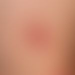 Tinea corporis. Mehrere, akut aufgetretene, ovale, rote, schuppige, am Randsaum betonte, zum Zent...