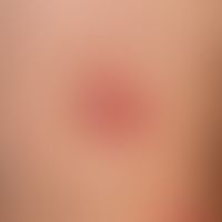 Tinea corporis. several, acutely appeared, oval, red, scaly, at the rim accentuated, towards the ...