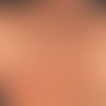 Tinea corporis. Großflächige, rötlich-bräunliche, randbetonte Herde im Bereich des Rückens, feinl...