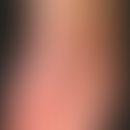 Tinea pedis "moccasin type": A little inflammatory only moderately sharply delimited scaly mycosi...