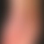 Tinea pedum. general view: Persistent redness and scaling, partly with severe itching, in the are...