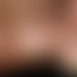 Tinea pedum. Mazerierte, weißliche, aufgequollene Haut im 4. Zwischenzehenraum bei einer 42-jähri...
