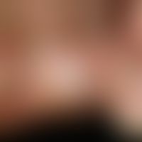 Tinea pedum. Mazerierte, weißliche, aufgequollene Haut im 4. Zwischenzehenraum bei einer 42-jähri...