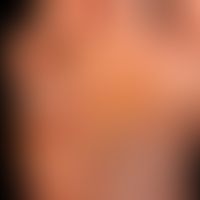 Tinea pedis interdigitaler Typ: Übelriechende, mazerierte, wie gekochte Haut des 4. Zehenzwischen...