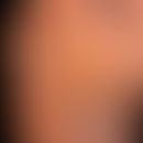 Tinea pedis interdigitaler Typ: Übelriechende, mazerierte, wie gekochte Haut des 4. Zehenzwischen...