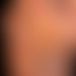 Tinea pedis interdigital type: foul-smelling, macerated, as if boiled skin of the 4th interdigita...