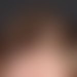 Trichotillomania; for 2 years in a 9-year-old boy a circumscribed, flat alopecia of varying exten...
