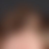Trichotillomania; for 2 years in a 9-year-old boy a circumscribed, flat alopecia of varying exten...