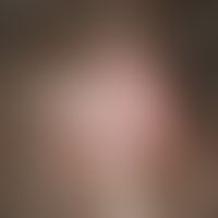 Alopecia, scarring alopecia in a 13-year-old female patient with known lupus erythematosus withou...