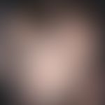 Alopecia areata. Rundliches, sich zentrifugal und medial ausbreitendes, glattes, haarloses Areal ...