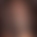 Alopecia androgenetica bei der Frau. Klassische, initiale, androgenetische Alopezie vom female pa...