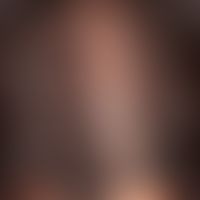 Alopecia androgenetica in the female. classic, initial androgenetic alopecia of the female patter...