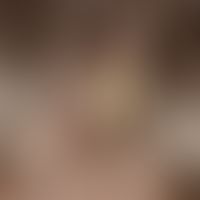 Pityriasis amiantacea: Massive greasy scaling, the hairs can be "tufted" in the affected areas an...