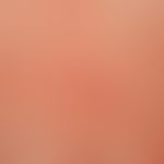 Teleangiectasia macularis eruptiva perstans. Detailaufnahme. Seit Jahren langsam progrediente "Ha...