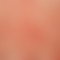 Teleangiectasia macularis eruptiva perstans. detailed view. since years slowly progressive "skin ...