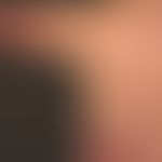 Teleangiectasia macularis eruptiva perstans. 54-jähriger Patient mit einem seit Jahren bestehende...