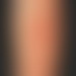 Teleangiectasia macularis eruptiva perstans. Seit Jahren langsam progrediente "Hautrötung" aus di...