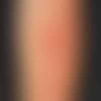 teleangiectasia macularis eruptiva perstans. for years slowly progressive "reddening" of the skin...