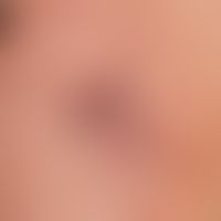 Besenreiser mit sternförmiger Ausstrahlung der kapillären und venösen Gefäße.
