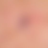 Detailaufnahme: ampullenartig erweitertes "venöses" Gefäß des dermnalen Gefäßplexus. Retikuläres ...