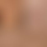 Transitorische akantholytische Dermatose (M.Grover): 32. Jahre alter ansonsten gesunder Mann. Sei...