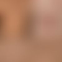 Transitorische akantholytische Dermatose (M.Grover): 32. Jahre alter ansonsten gesunder Mann. Sei...