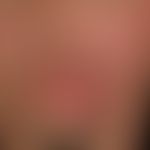 Tinea faciei: seit mehreren Monatn bestehende, langsam progrediente Plaques, bogig begrenzte, rot...