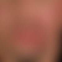 Tinea faciei: seit mehreren Monatn bestehende, langsam progrediente Plaques, bogig begrenzte, rot...