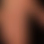 Tinea manuum, impetiginierte: seit mehreren Monaten bestehende,&nbsp;randständig betonte,&nbsp; g...