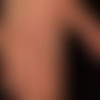 Tinea manuum, impetiginierte: seit mehreren Monaten bestehende,&nbsp;randständig betonte,&nbsp; g...
