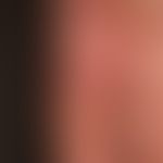 Tinea manuum: Detailaufnahme.
