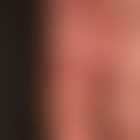 Tinea manuum: Detailaufnahme.

