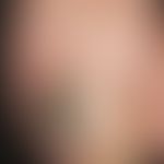 tinea unguium: black dyschromia of the nail plate localized at the left big toe of a 52-year-old ...