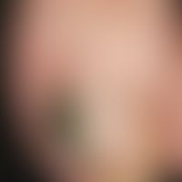 tinea unguium: black dyschromia of the nail plate localized at the left big toe of a 52-year-old ...