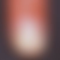 Tinea unguium: distalsubungual discoloration in fungal infection; the nail matrix is crumbled und...