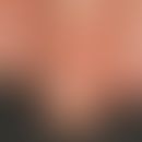 Trachyonychie: raue, glanzlose, ansonsten symptomlose Nageloberflächen bei Alopecia areata totali...