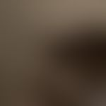 Trichorrhexis nodosa. broken, difficult to comb, stubborn hair. conspicuous abrupt kinking of the...