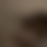 Trichorrhexis nodosa. broken, difficult to comb, stubborn hair. conspicuous abrupt kinking of the...